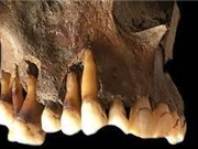 DNA trong răng cổ đại tiết lộ lịch sử tiến hóa virus herpes 